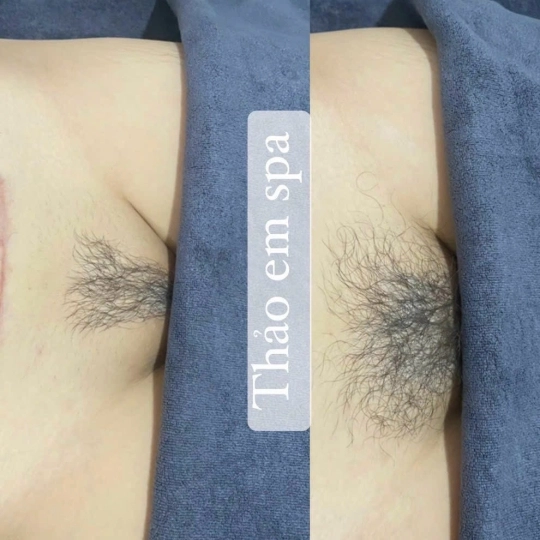 Triệt  bikini bảo hành trọnđời