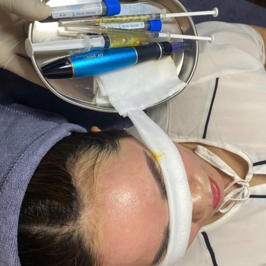 Tiêm - Cấy huyết thanh tự thân