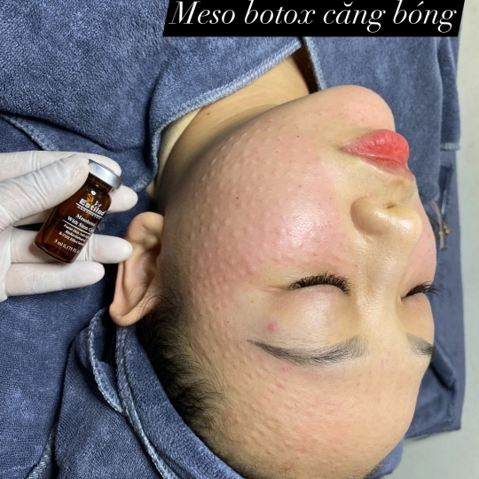 Tiêm Meso căng bóng - trẻ hoá 
