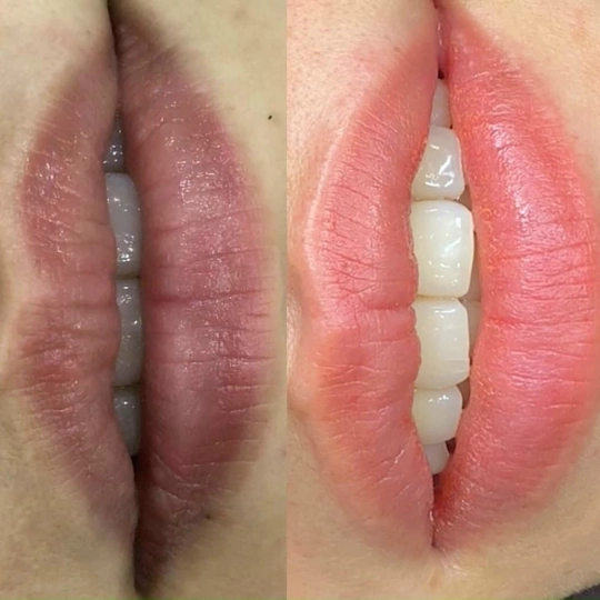 Phun khử thâm môi