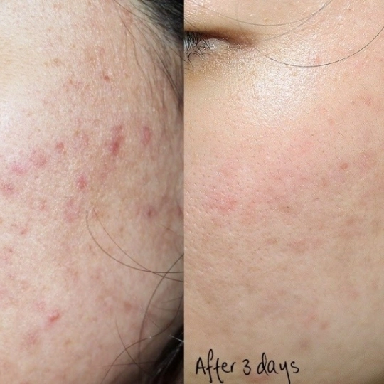 Bắn trị thâm - trẻ hóa công nghệ IPL