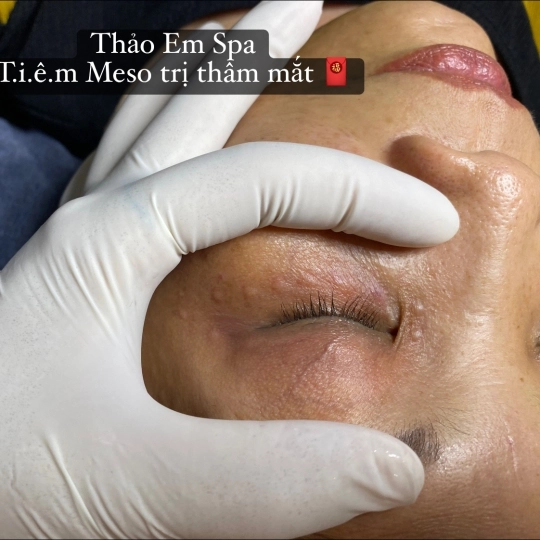 Tiêm tinh chất giảm thâm bọng mắt