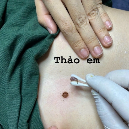 Xóa mụn ruồi - Mụn thịt - Chấm nốt ruồi son