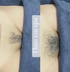 Triệt  bikini bảo hành trọnđời