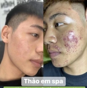 Trị mụn chuyên sâu (y khoa)