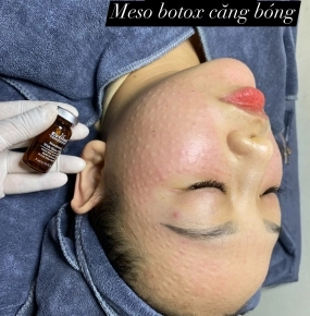 Tiêm Meso căng bóng - trẻ hoá 