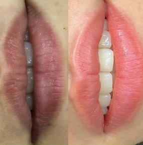 Phun khử thâm môi