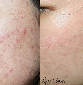 Bắn trị thâm - trẻ hóa công nghệ IPL