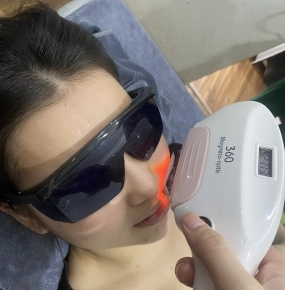 Triệt mép  bảo hành trọn đời 