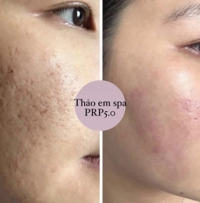 PRP 5.0 - Tách đáy sẹo rỗ (huyết thanh tự thân)