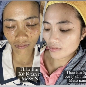 Xử lý tàn nhang TCA