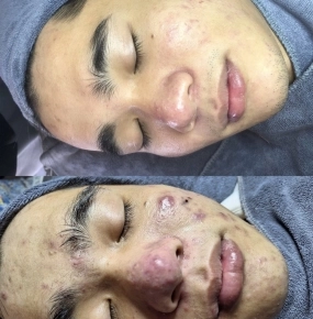 Trị mụn Acne