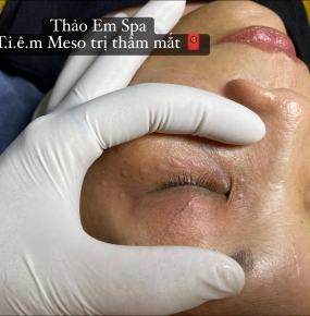 Tiêm tinh chất giảm thâm bọng mắt