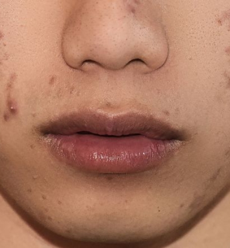 Các phương pháp trị thâm do mụn hiệu quả và an toàn